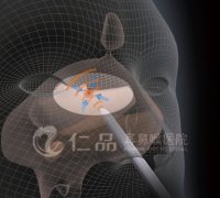 “HIFU飞波”无形秒杀术