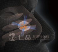 美国“LTPM术”