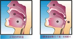 打呼噜会造成哪些危害