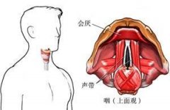 急慢性喉炎的症状表现