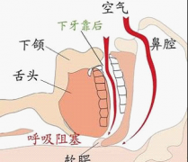 如何预防老年人打呼噜