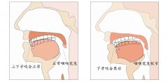 南京哪里治打鼾好 打呼噜怎么治疗