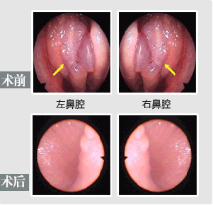 鼻炎术前术后对比